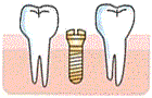 インプラントの埋め込み