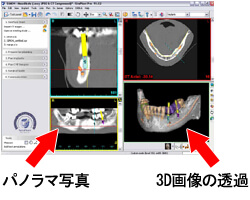 インプラント治療のシミュレーション